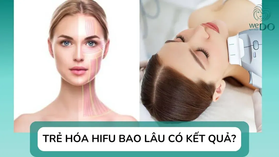 Làm Hifu bao lâu thì có kết quả? Duy trì được bao lâu?