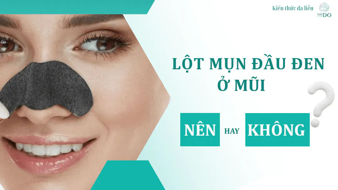 Lột mụn đầu đen ở mũi – có nên hay không?