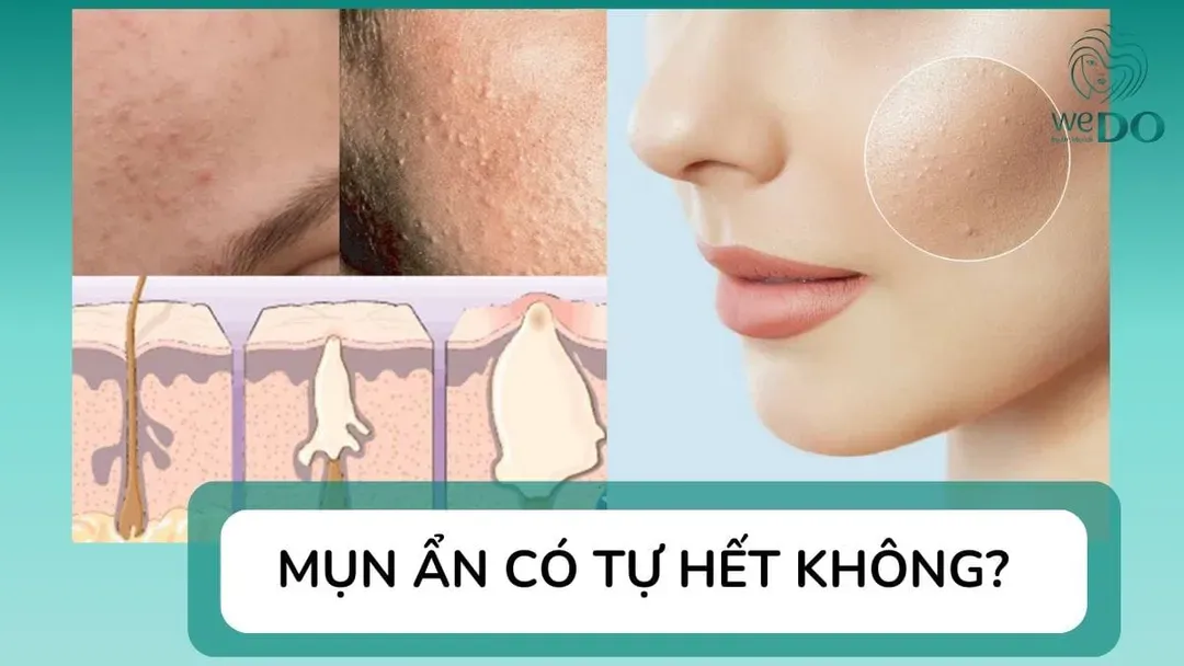 Mụn ẩn có tự hết không? Bị mụn ẩn phải làm sao?