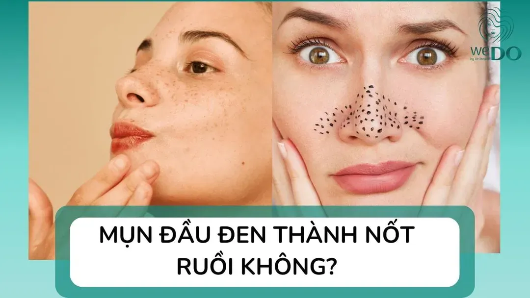 Mụn đầu đen để lâu có thành nốt ruồi không? Để lâu có sao không?