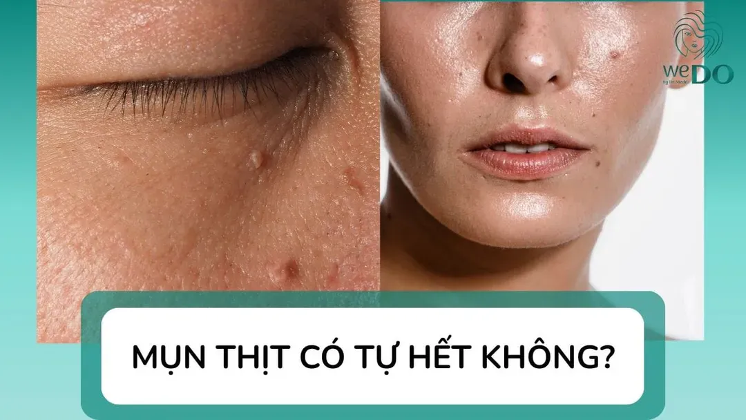 Mụn thịt có tự hết không? Có nên đốt mụn thịt?
