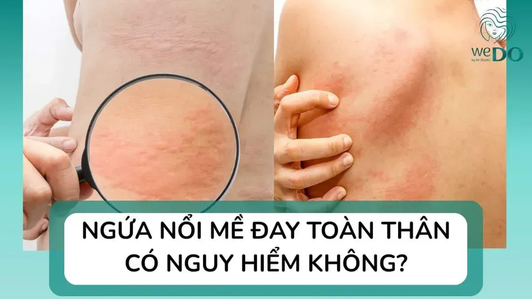 Ngứa nổi mề đay toàn thân có nguy hiểm không? Làm sao để hết ngứa?