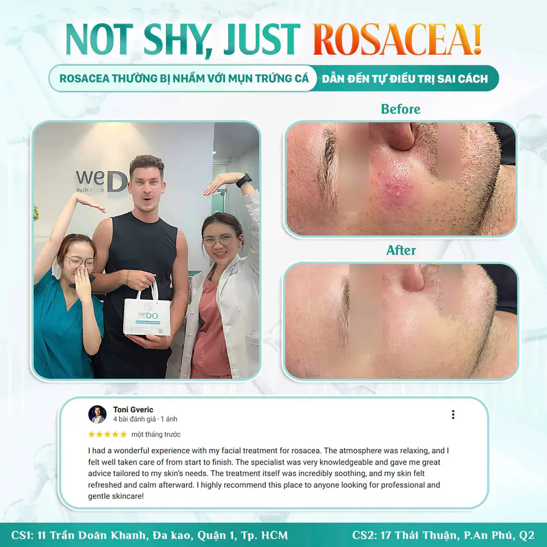 Rosacea – a hidden skin condition that’s often misdiagnosed | Rosacea – một “kẻ giấu mặt” khiến không ít người nhầm lẫn