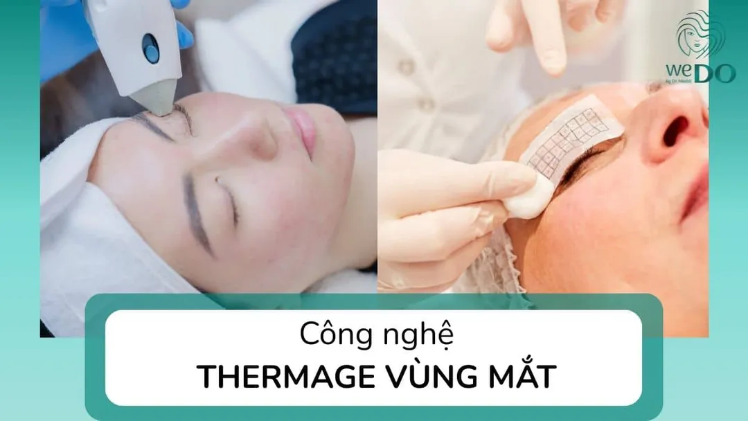 6 điều cần biết về công nghệ Thermage vùng mắt
