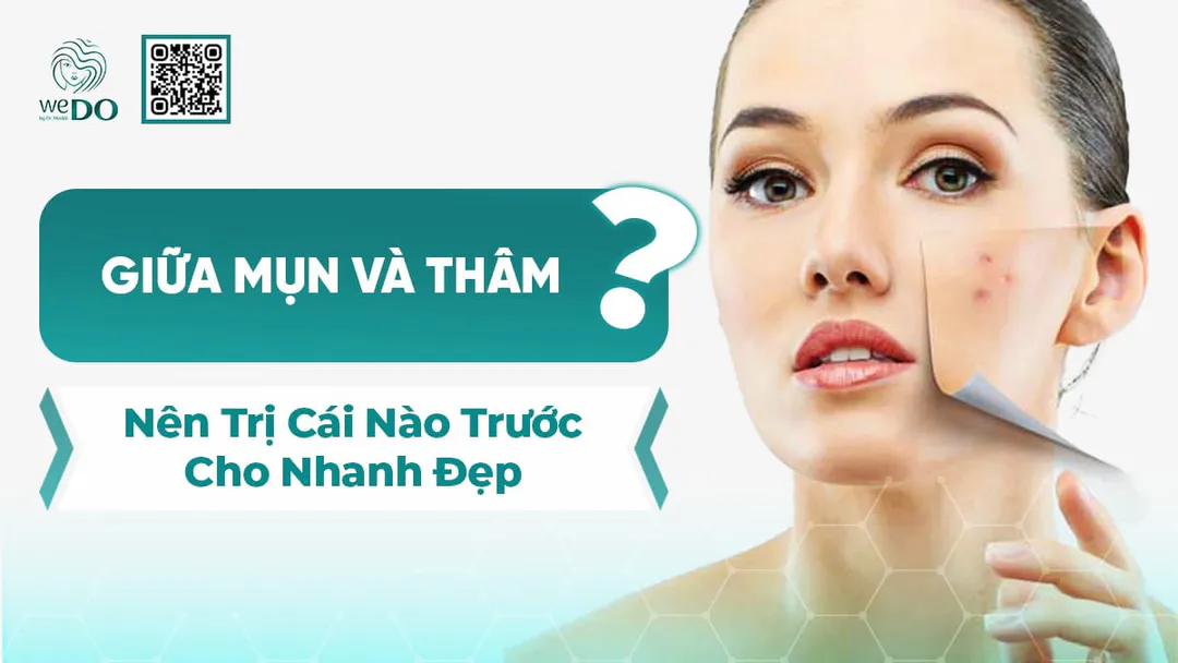 Nên trị mụn hay trị thâm trước để da nhanh đẹp?