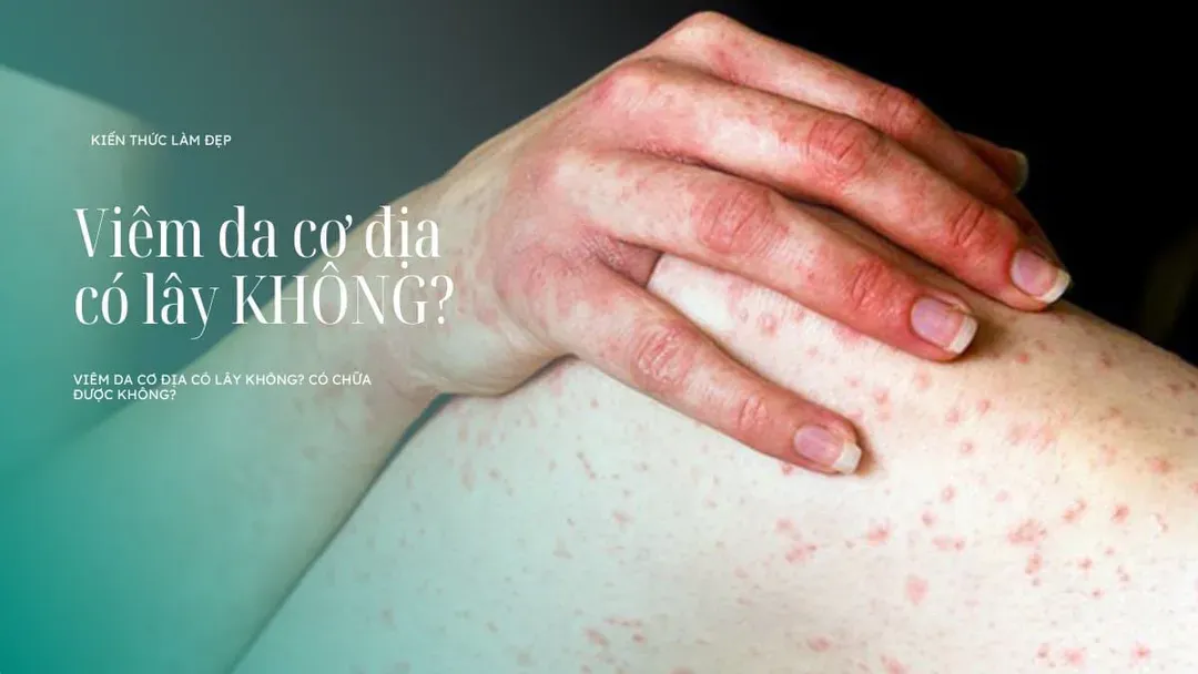 Viêm da cơ địa có lây không? Có chữa được không?