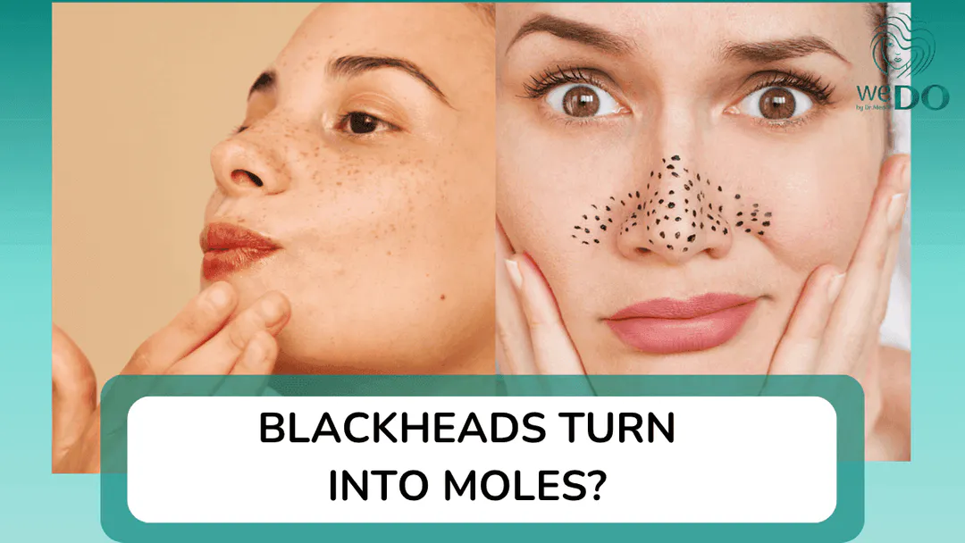 Will blackheads turn into moles if left for a long time? Is it okay to leave them for a long time?