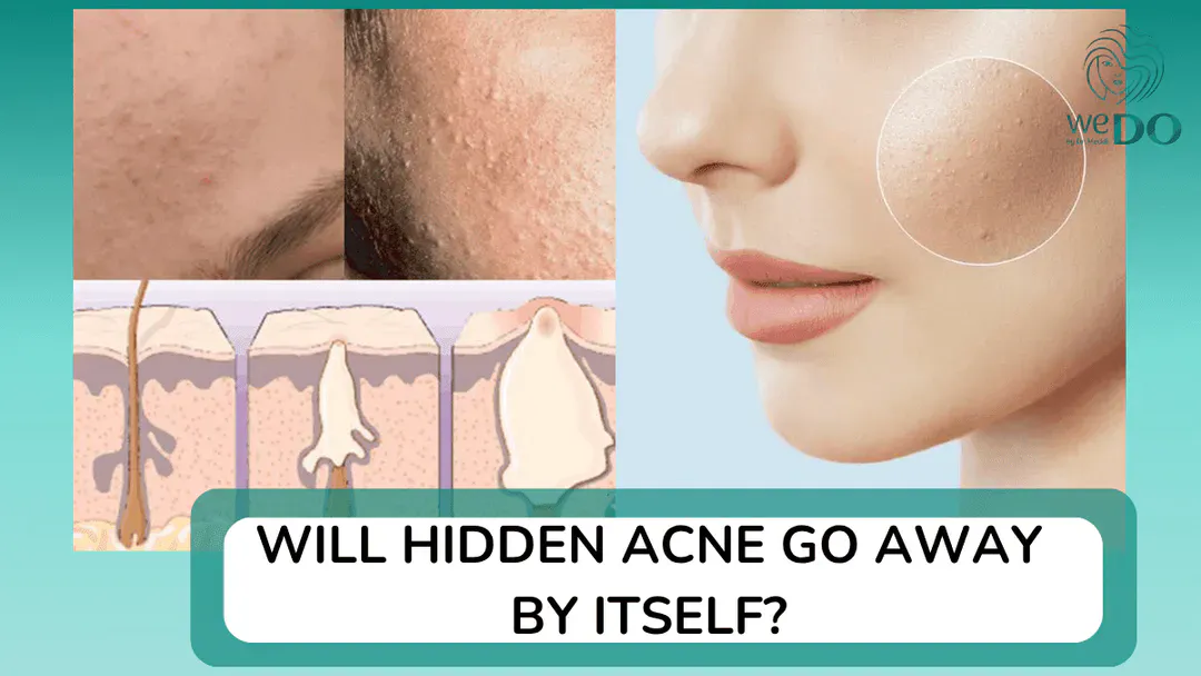 Will hidden acne go away on its own? What should I do if I have hidden acne?