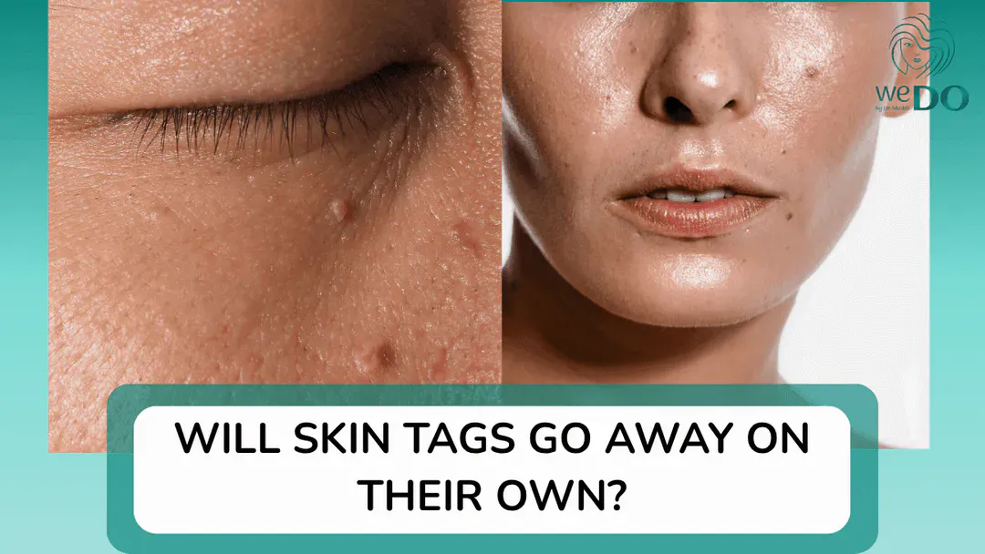 Will skin tags go away on their own? Should skin tags be burned?
