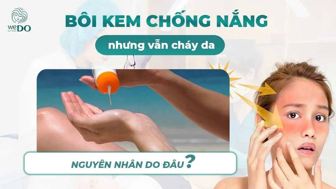 Bôi kem chống nắng nhưng da vẫn cháy, nguyên nhân do đâu?