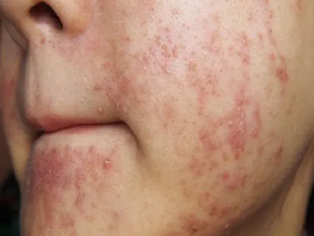 Có thể trị mụn tận gốc được không