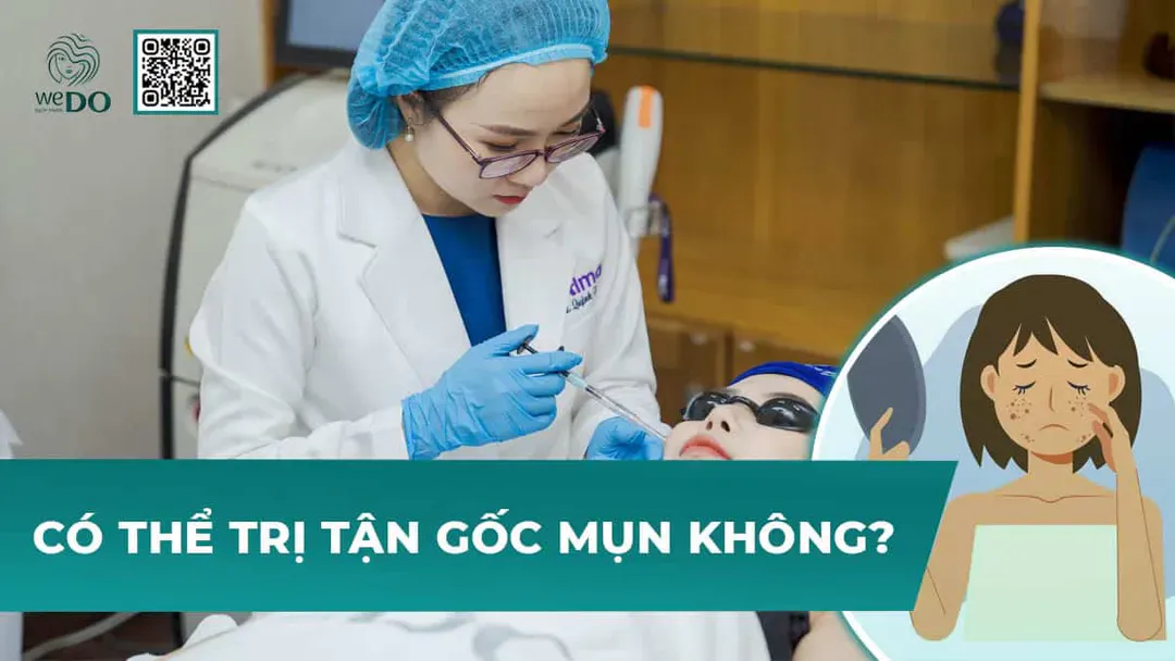 Có thể trị mụn tận gốc được không?