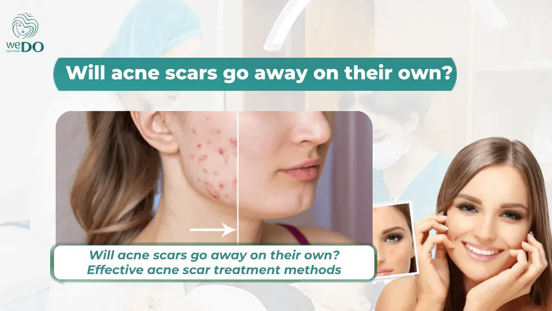 Will acne scars go away on their own? Effective acne scar treatment methods