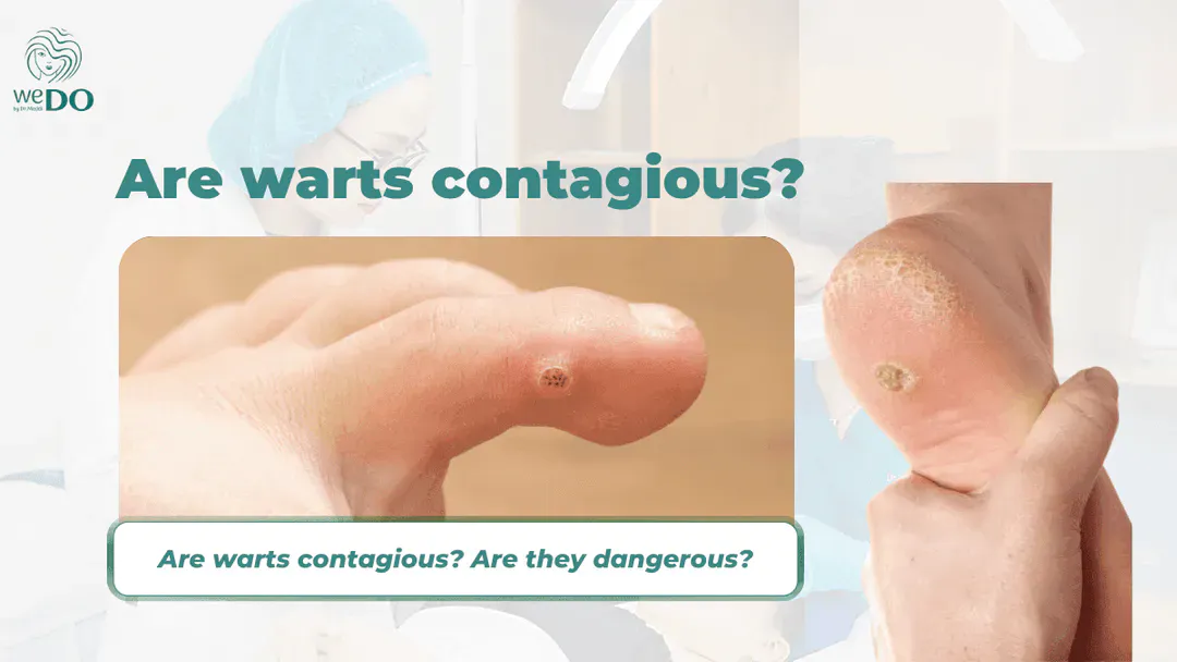 Are warts contagious? Are they dangerous?