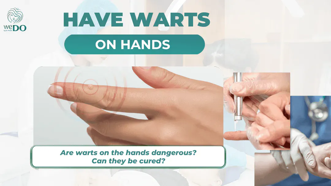 Are warts on hands dangerous? Can they be cured?