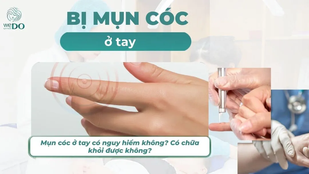 Mụn cóc ở tay có nguy hiểm không? Có chữa khỏi được không?
