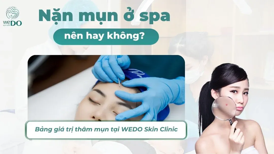 Có nên đi nặn mụn ở spa không? Lợi ích và rủi ro khi nặn mụn