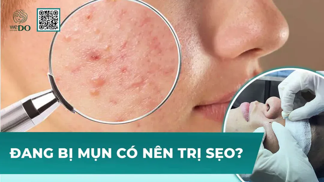 Đang bị mụn có nên trị sẹo?