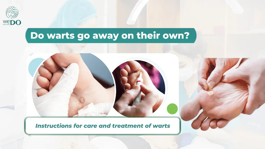 Do warts go away on their own? What should I do if I have warts?