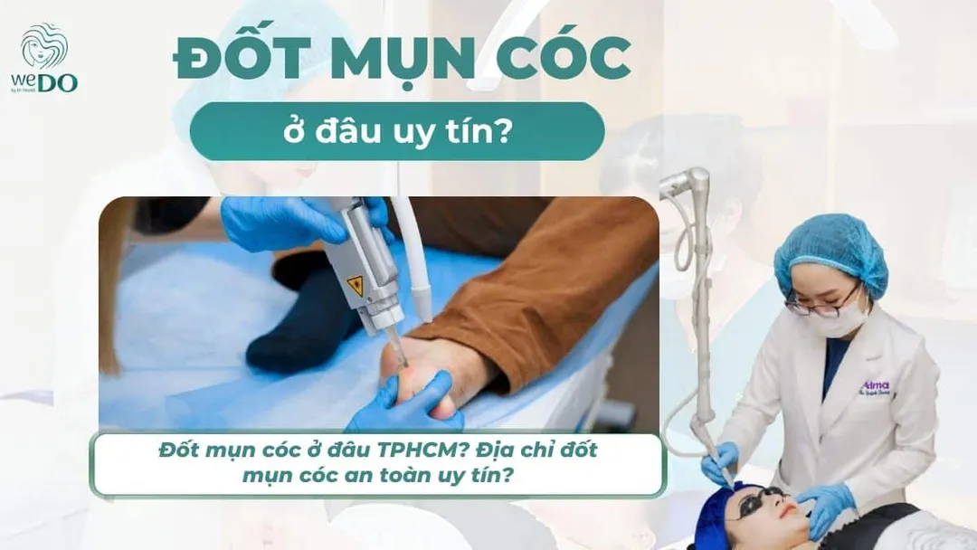 Đốt mụn cóc ở đâu TPHCM? Địa chỉ đốt mụn cóc an toàn uy tín