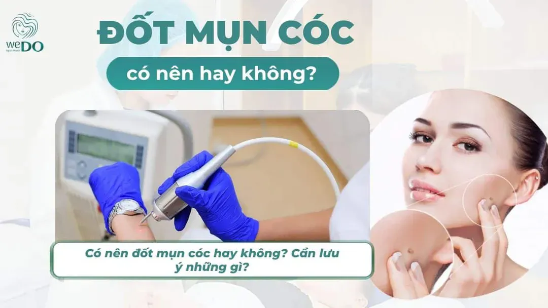 Có nên đốt mụn cóc hay không? Cần lưu ý những gì?