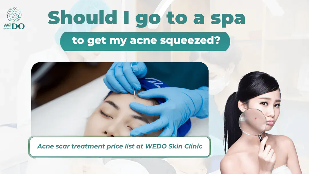 Should I go to a spa to get my acne squeezed? Benefits and risks of squeezing acne