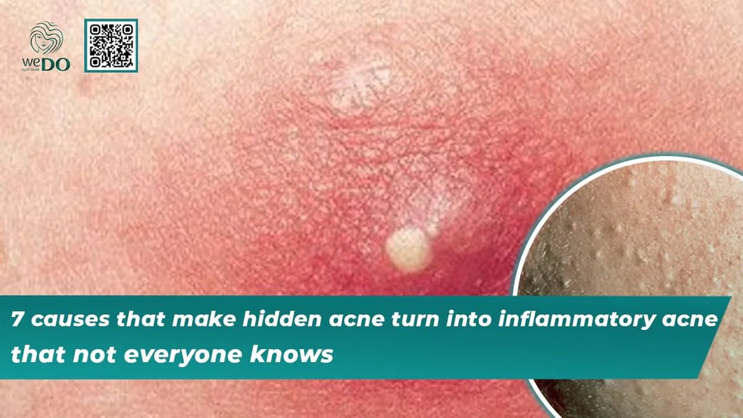 7 reasons why hidden acne turns into inflammatory acne that not everyone knows