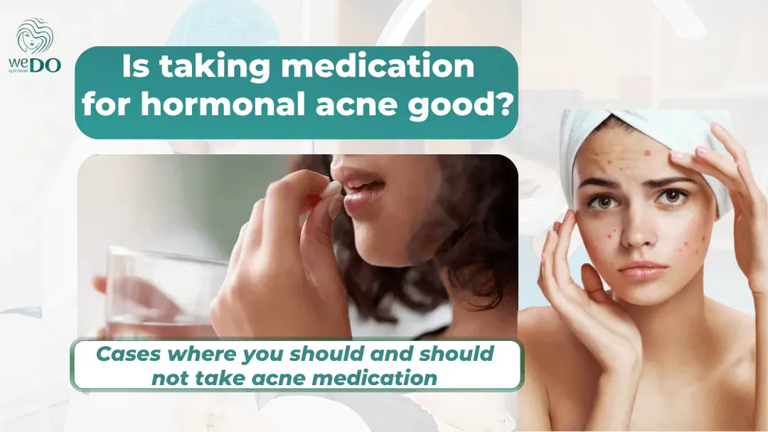 Is taking medication for hormonal acne good?