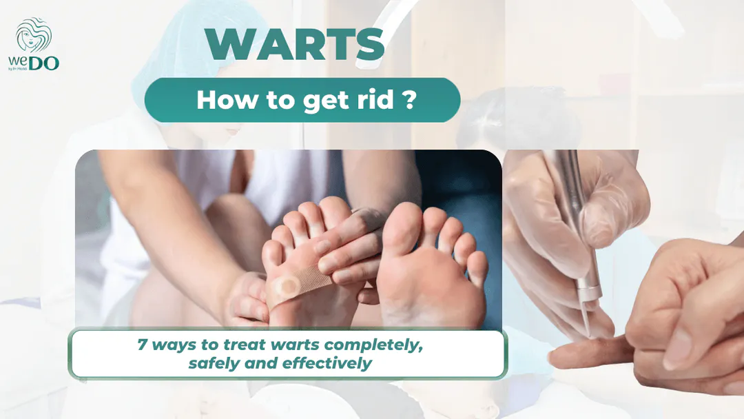 How to get rid of warts? 7 ways to treat them completely, safely and effectively