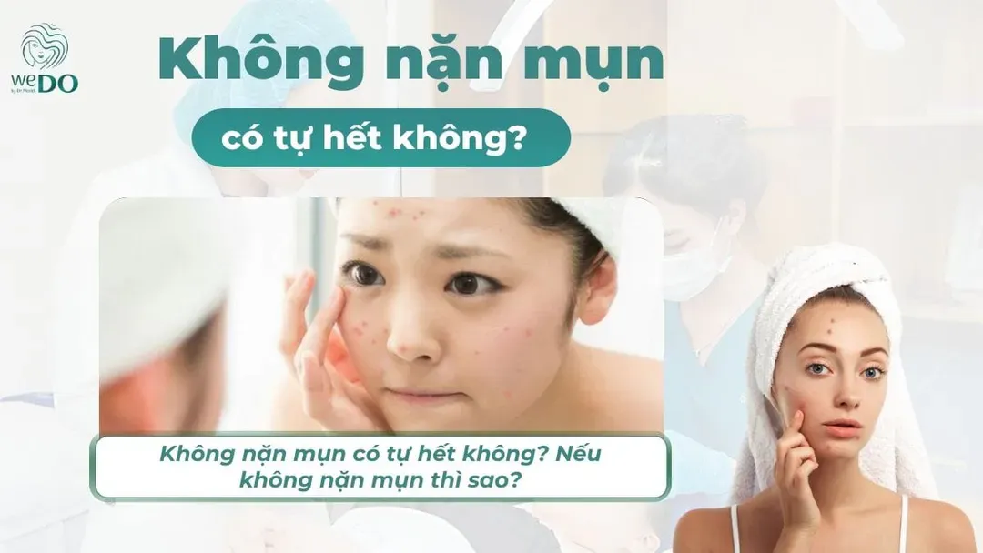 Không nặn mụn có tự hết không? Nếu không nặn mụn thì sao?