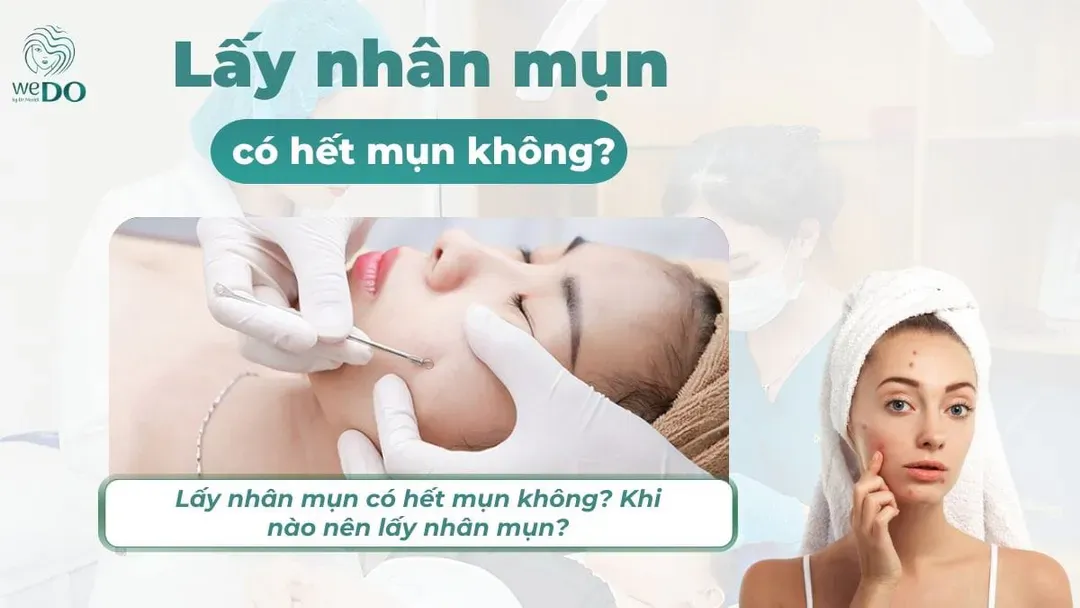 Lấy nhân mụn có hết mụn không? Khi nào nên lấy nhân mụn?