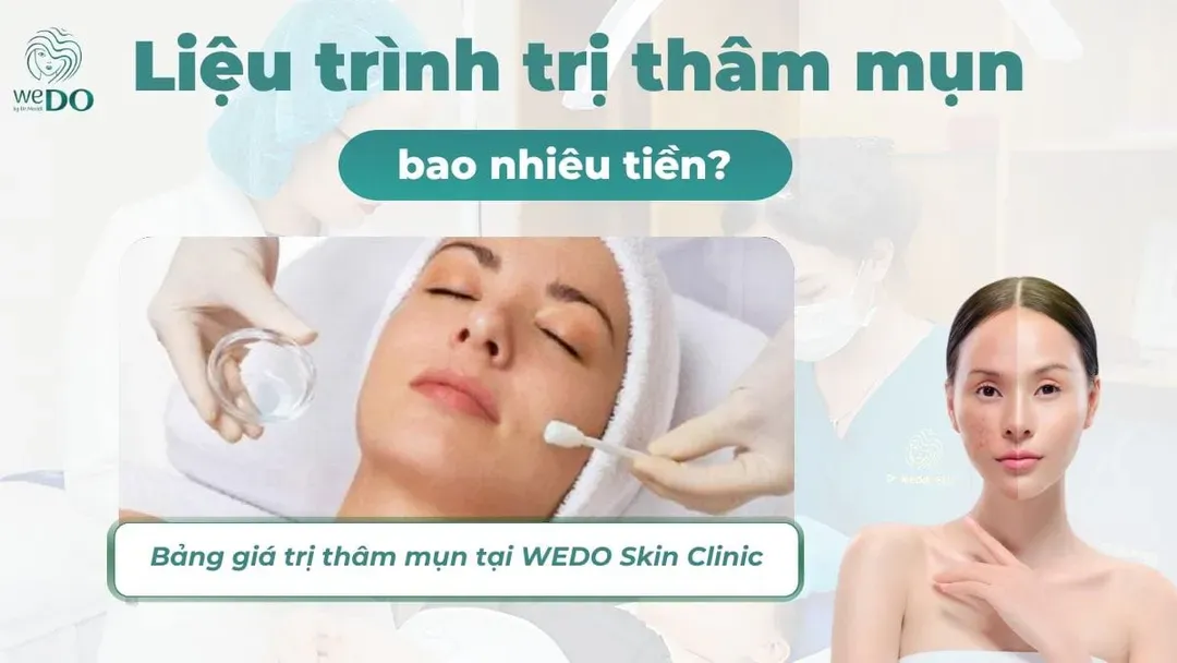 Liệu trình trị thâm mụn bao nhiêu tiền? Bảng giá trị thâm mụn tại WEDO Skin Clinic