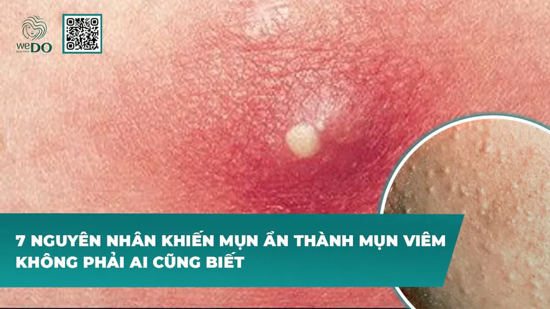 7 nguyên nhân khiến mụn ẩn thành mụn viêm không phải ai cũng biết