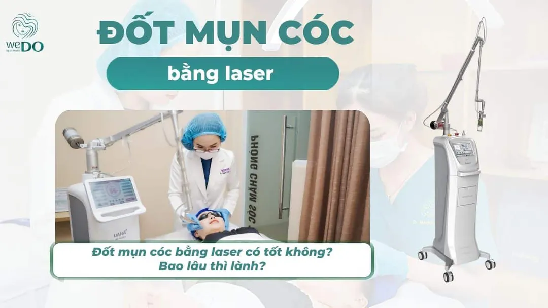 Đốt mụn cóc bằng laser có tốt không? Bao lâu thì lành?