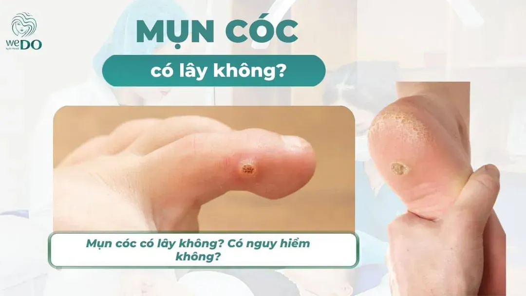 Mụn cóc có lây không? Có nguy hiểm không?