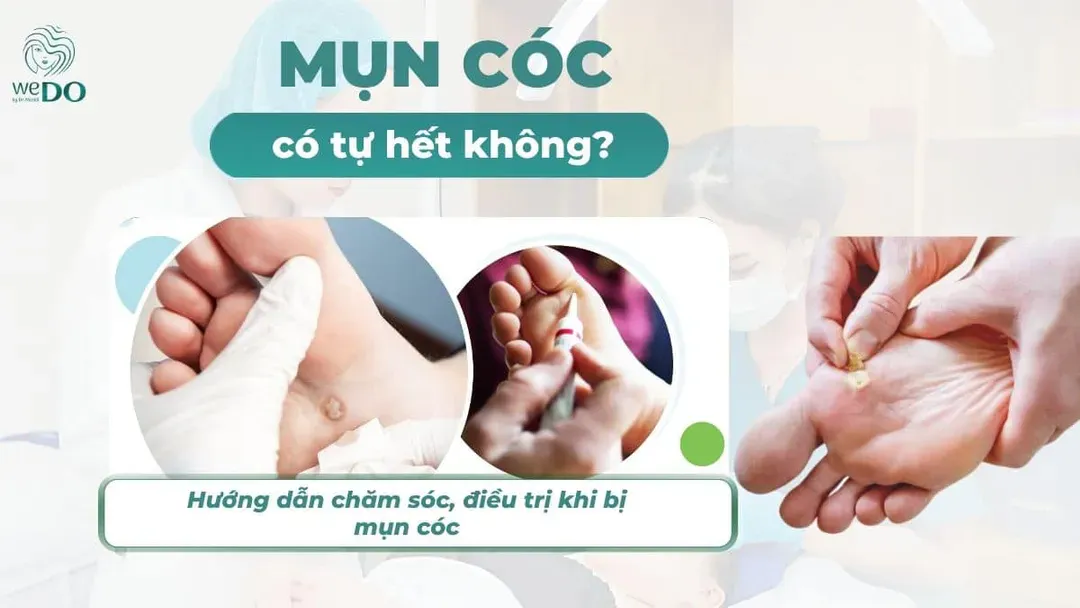 Mụn cóc có tự hết không? Nên làm gì khi bị mụn cóc?