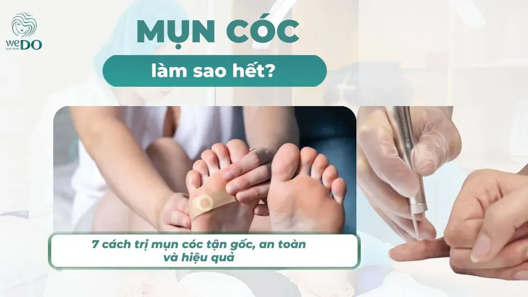 Mụn cóc làm sao hết? 7 cách trị tận gốc, an toàn, hiệu quả
