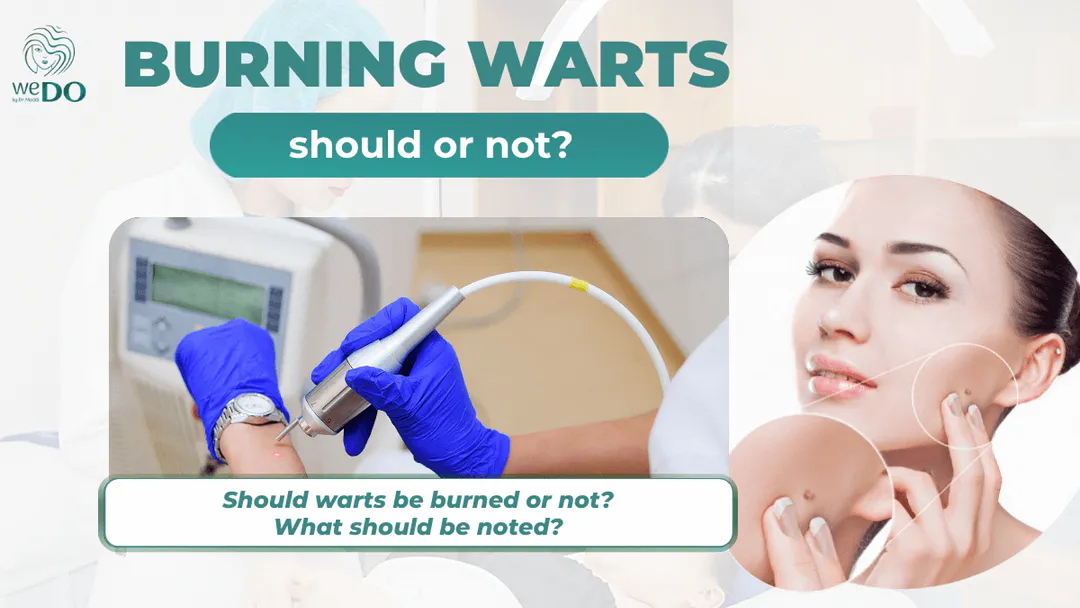 Should warts be burned or not? What should be noted?