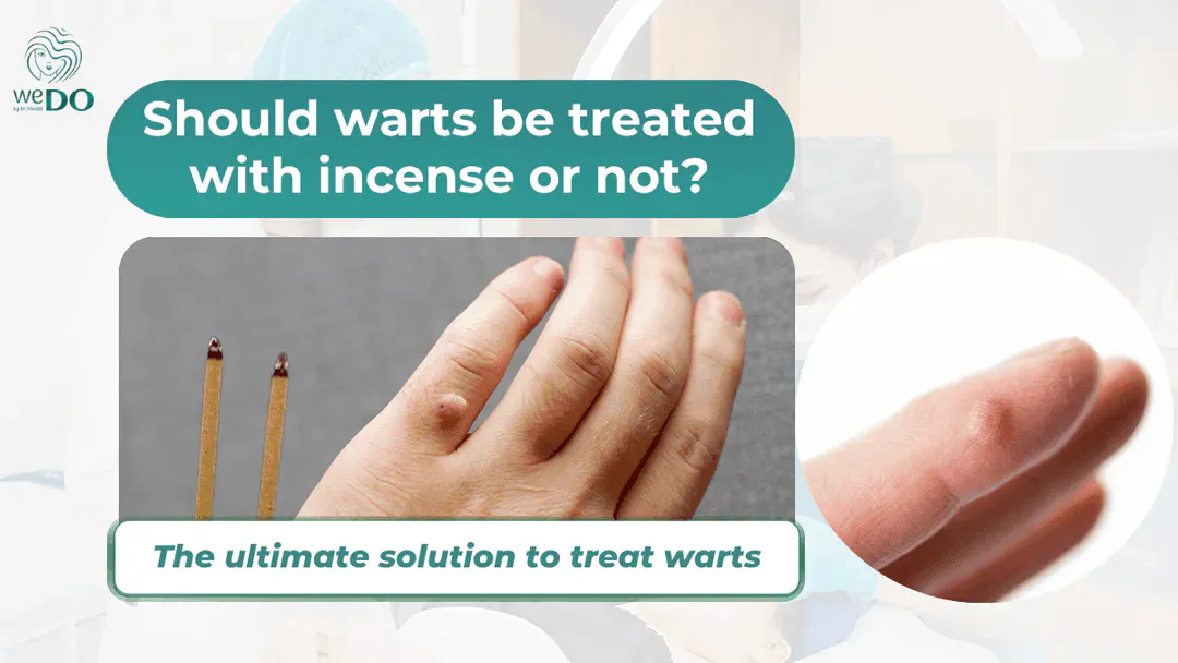 Should warts be treated with incense or not? The solution to cure warts from the root