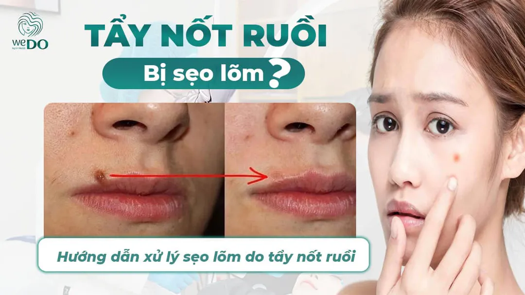 Tẩy nốt ruồi bị sẹo lõm phải làm sao?