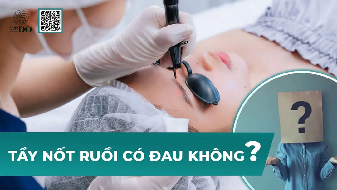Tẩy nốt ruồi có đau không?