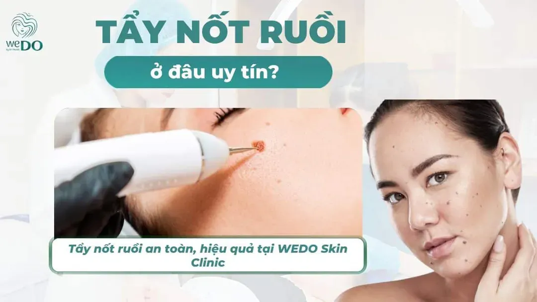 Tẩy nốt ruồi ở đâu an toàn, hiệu quả tại TPHCM?
