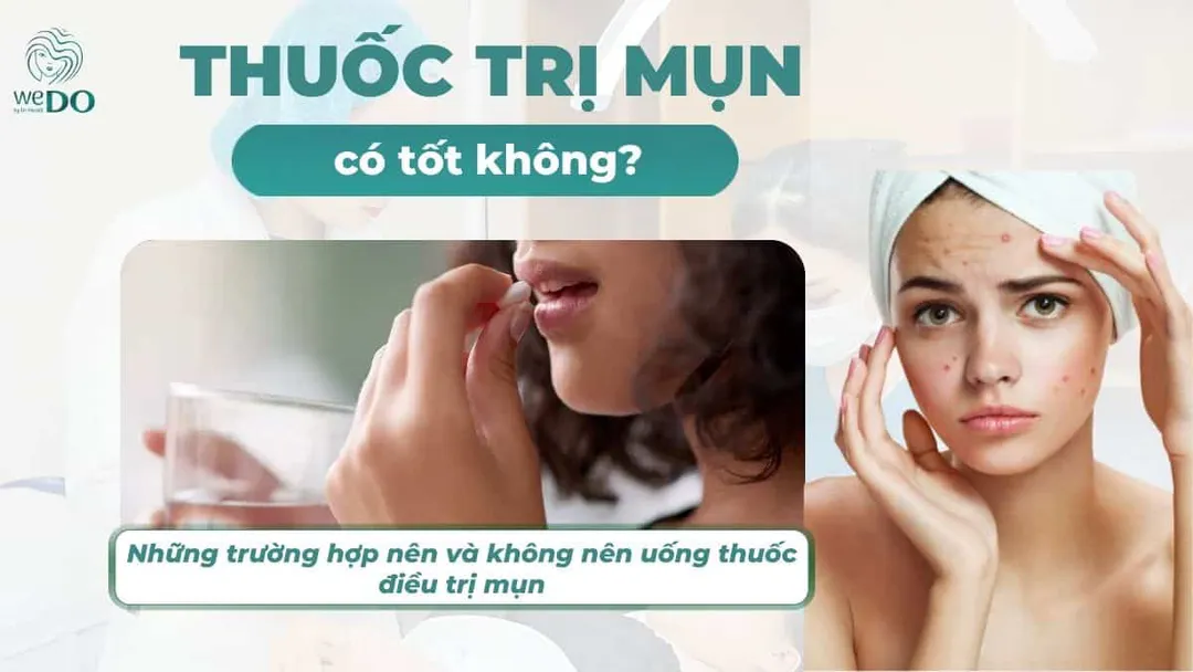Uống thuốc trị mụn nội tiết có tốt không?