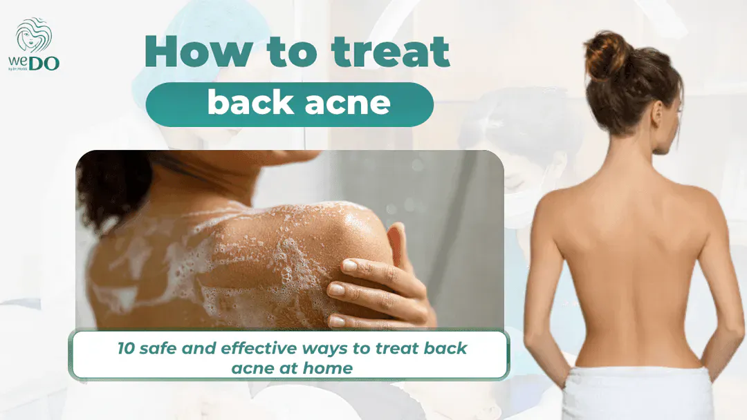 10 safe and effective ways to treat back acne at home