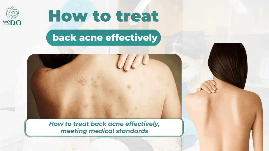 How to treat back acne effectively, meeting medical standards