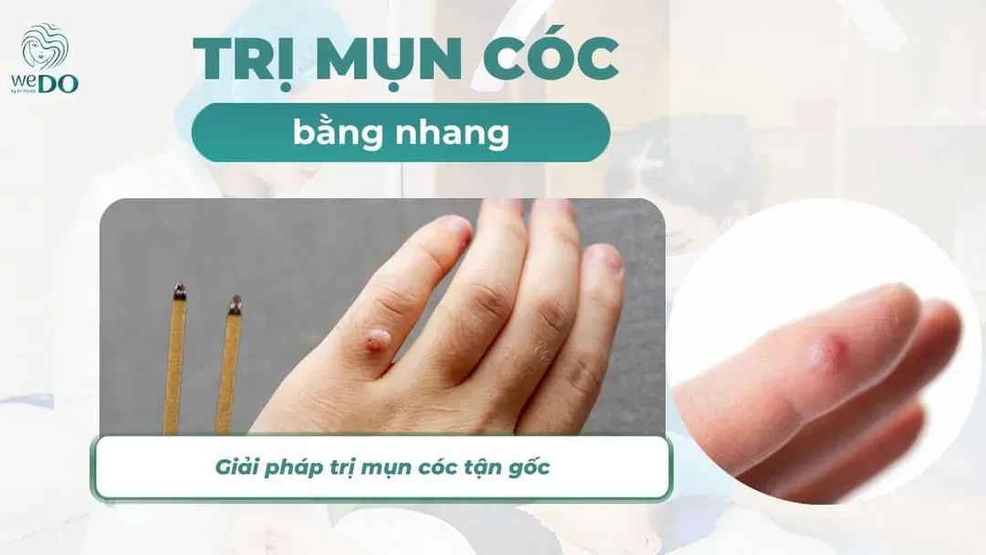 Có nên trị mụn cóc bằng nhang hay không? Giải pháp trị mụn cóc tận gốc