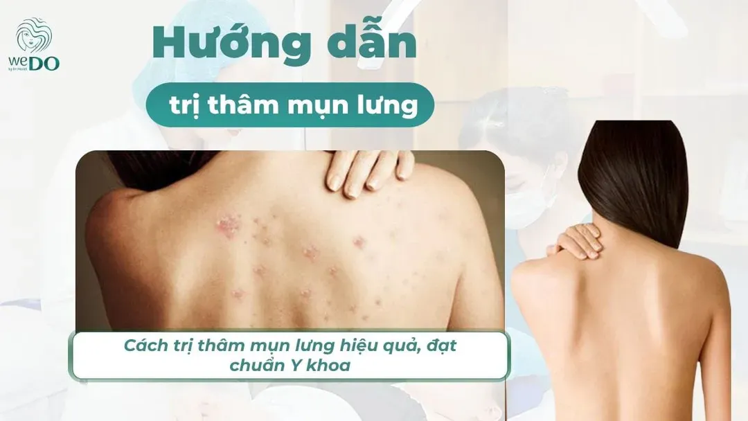 Cách trị thâm mụn lưng hiệu quả, đạt chuẩn Y khoa