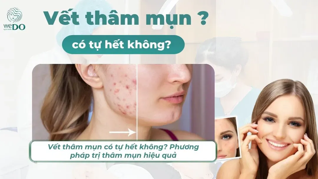 Vết thâm mụn có tự hết không? Phương pháp trị thâm mụn hiệu quả