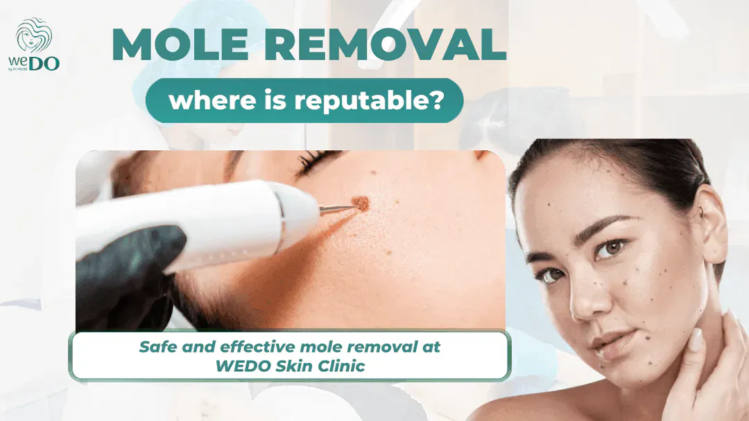 Where is a safe and effective place to remove moles in Ho Chi Minh City?