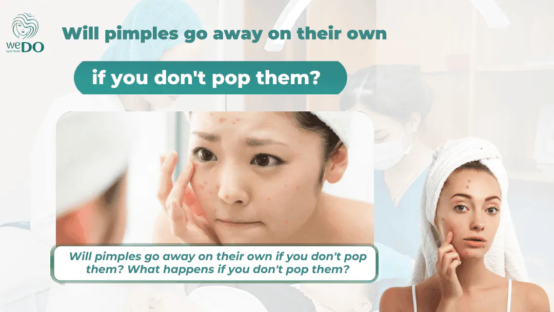 Will pimples go away on their own if you don’t pop them? What happens if you don’t pop them?